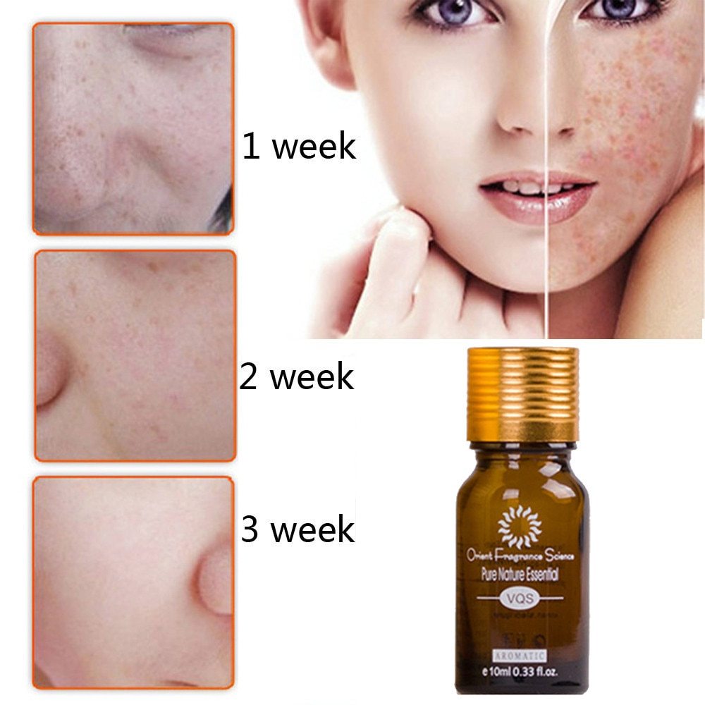 Natural Removal Acne Stretch Marks Scar oil